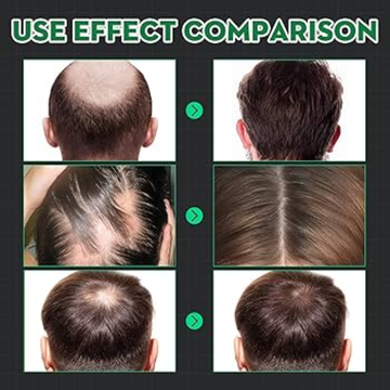 Proskire Hair Growth Serum – Reduces Hair Fall, Boosts Density, Activates Follicles – For Bald Patches, Receding Hairline & Thinning Hair